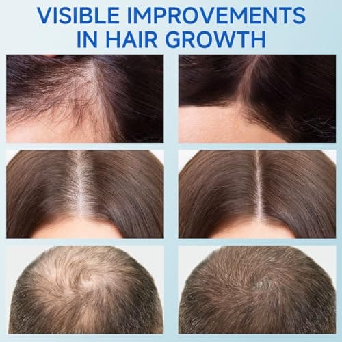 Hair Growth Serum Roll On, Rosemary Oil for Hair Growth, Be Roll On Rosemary Plant Essential Oils Extract Helps Support Body Thicker Fuller Hair for Men Women Pick - Thumbnail 5