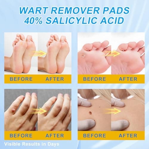ZGjoib WART Corn Remover Pads for Feet 40% Salicylic Acid Wart Remover Pads, Corn Removers for Toes,Body - Thumbnail 3