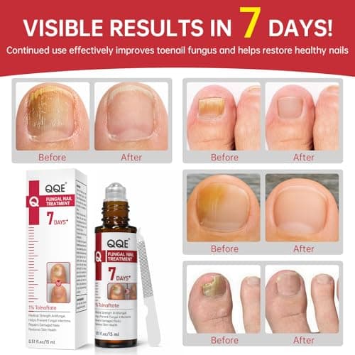 Nail Fungus Treatment Extra Strength – 1% Tolnaftate, Effective Treatment Under and Around Nails, Repairs Damaged Nails, Plant-Based Gentle Formula for Thickened and Discolored Nails, 0.51 fl.oz - Thumbnail 4